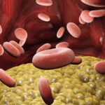Hypertriglyceridemia ภาวะไตรกลีเซอไรด์สูงในเลือด