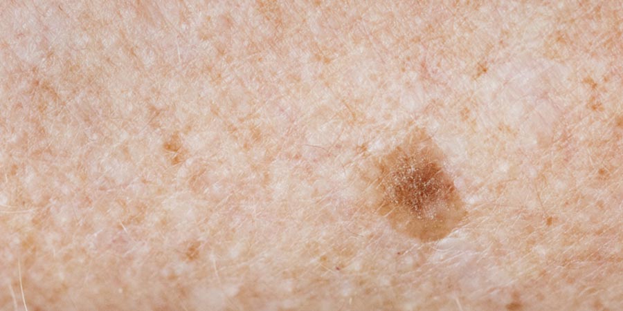 Smart phone ตรวจมะเร็งผิวหนัง