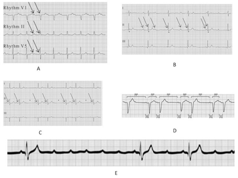 Management of bradycardia attributable to AV block