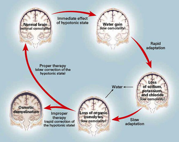 How to Deal and Prevent Overcorrection of Hyponatremia