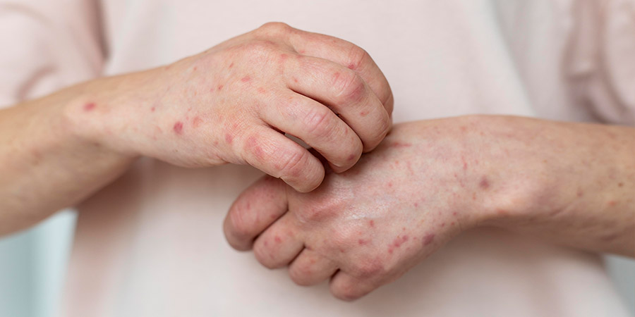 Zoonotic sporotrichosis