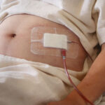 การล้างไตทางช่องท้องในผู้ป่วยโรคไตลูปัสร่วมกับน้ำในช่องท้อง