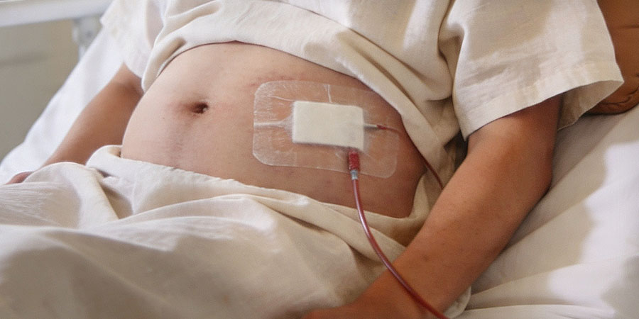 การล้างไตทางช่องท้องในผู้ป่วยโรคไตลูปัสร่วมกับน้ำในช่องท้อง